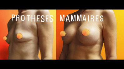 PROTHESES MAMMAIRES